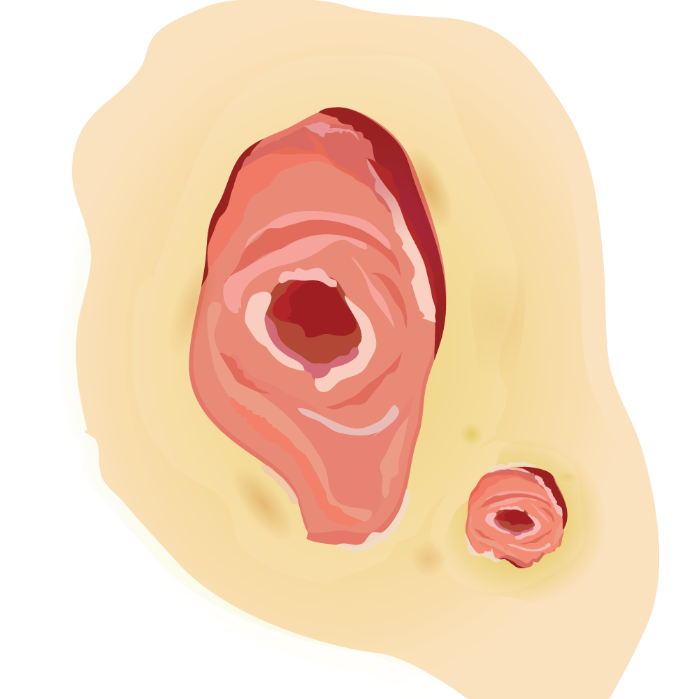 illustration of an open wound