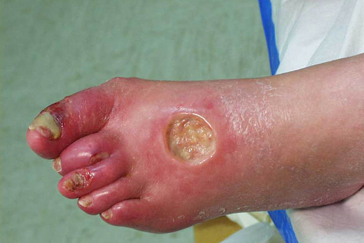 photo of an arterial foot ulcer