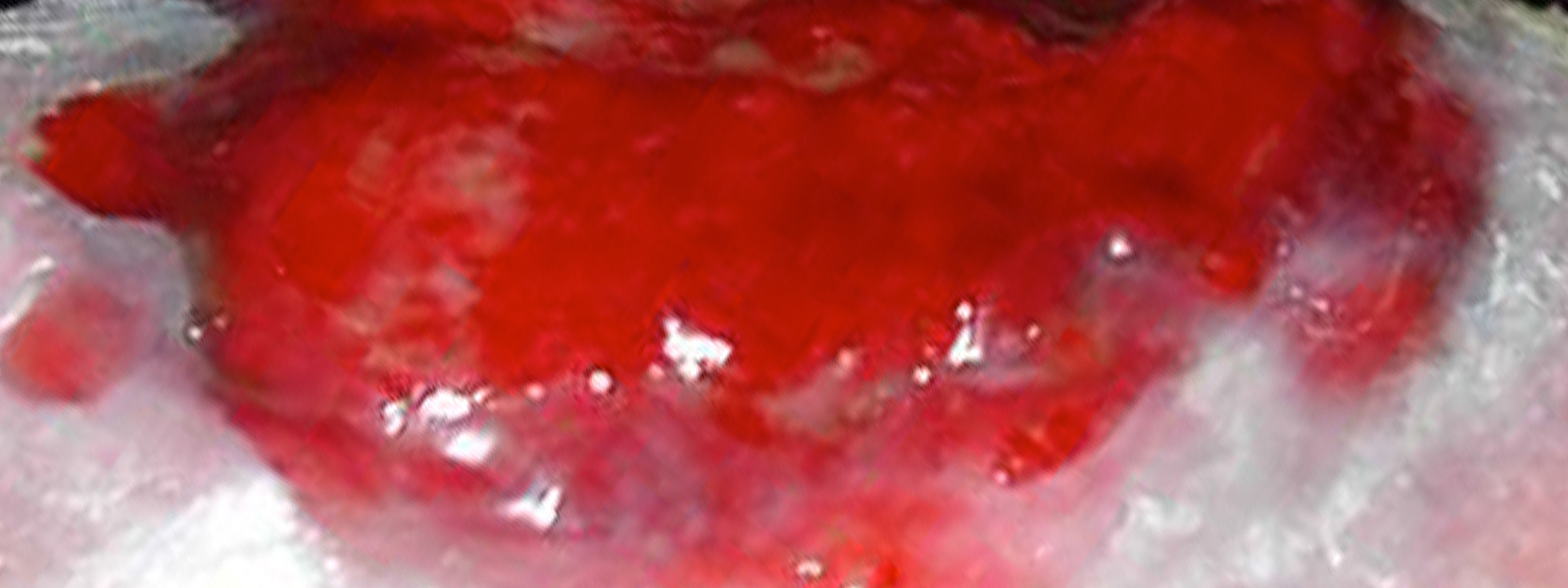 photo of hypergranulation tissue on a wound
