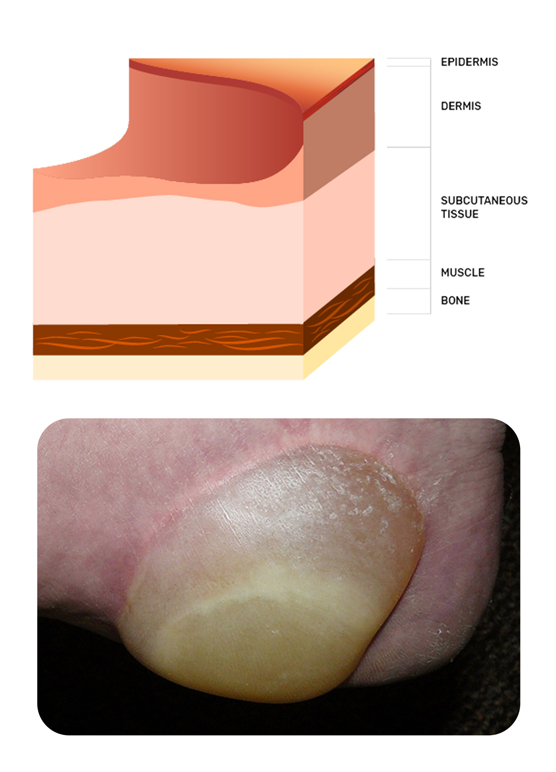 Stage 2 of a pressure injury on the heel of a foot | Image