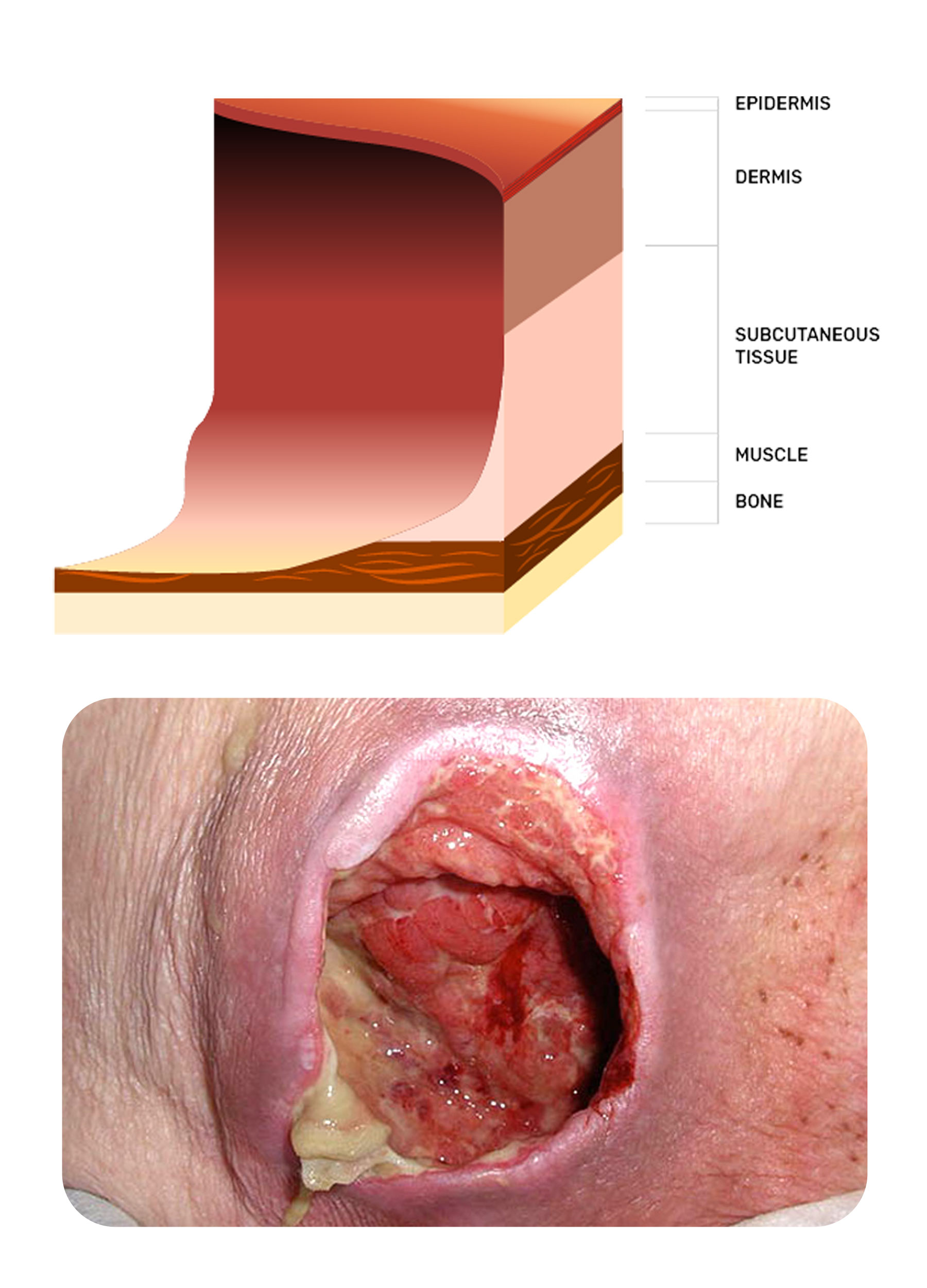 photo of a stage four pressure injury