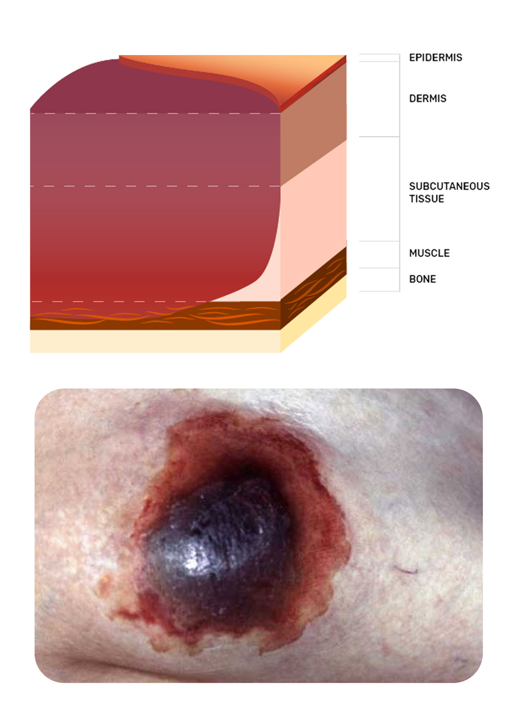 Stage 6 of a pressure injury on the heel of a foot | Image